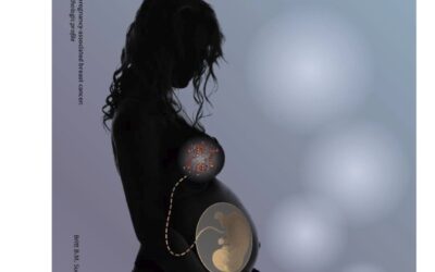 Heftiger verloop borstkanker tijdens en na zwangerschap